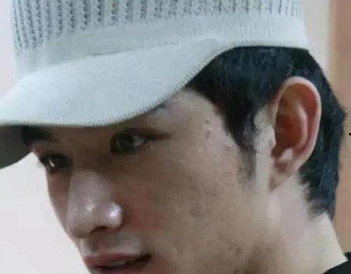 男明星脸上的痘坑照片,探寻肌肤故事